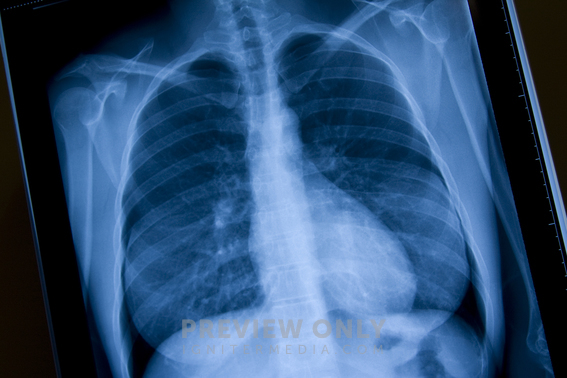 Chest Xray. - Stock Photos | Prixel Creative